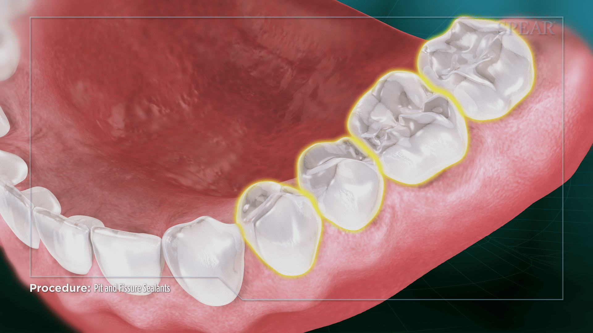 Teeth Evaluation for Sealants at SmileMore Dental