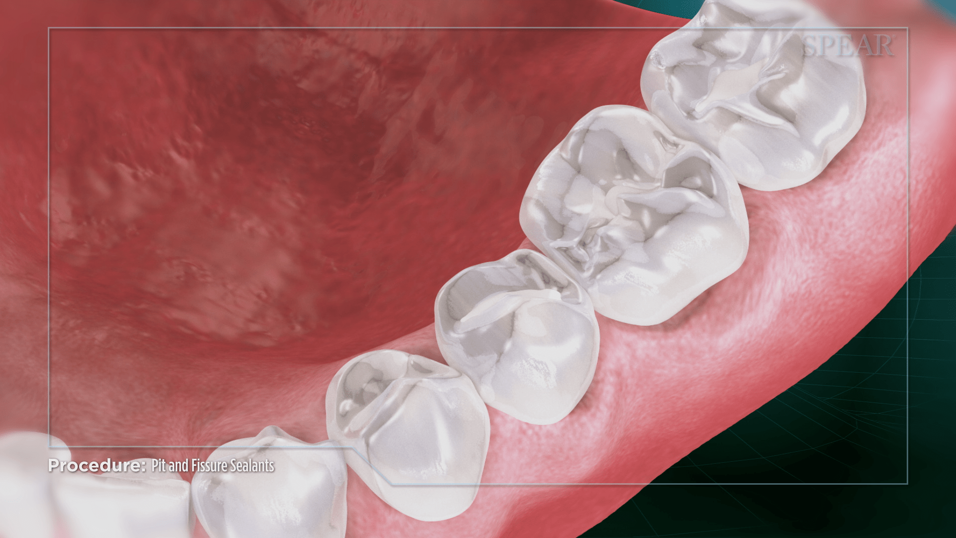 pit and fissure sealants 7