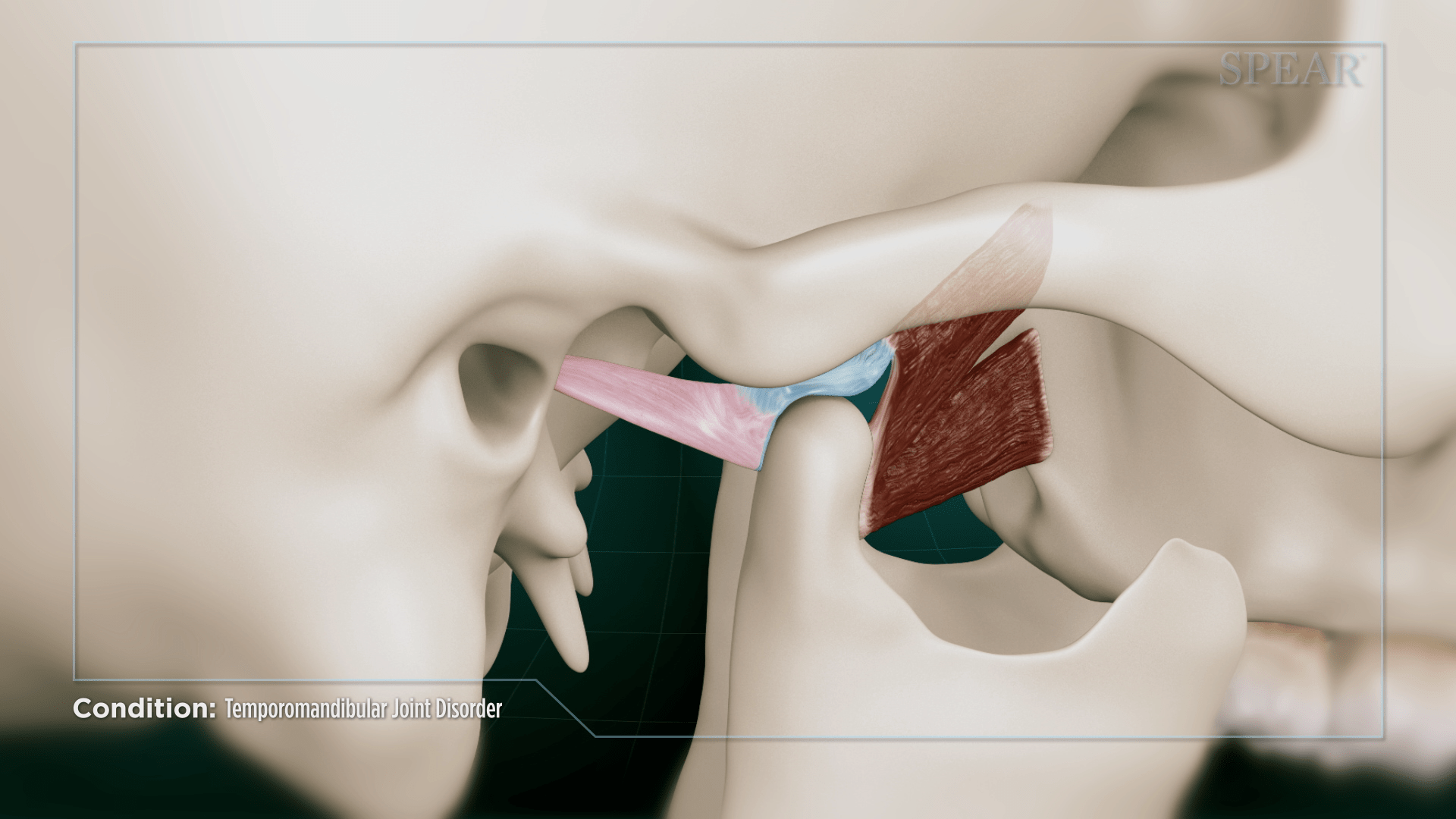 temporomandibular joint disorder 2