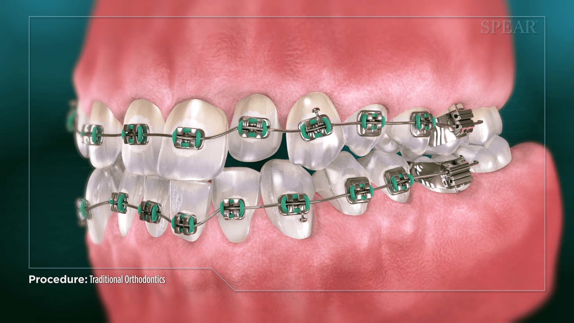 traditional orthodontics 5